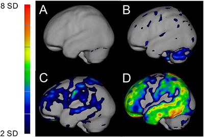 Cerebellar and Cerebral Amyloid Visualized by [18F]flutemetamol PET in Long-Term Hereditary V30M (p.V50M) Transthyretin Amyloidosis Survivors